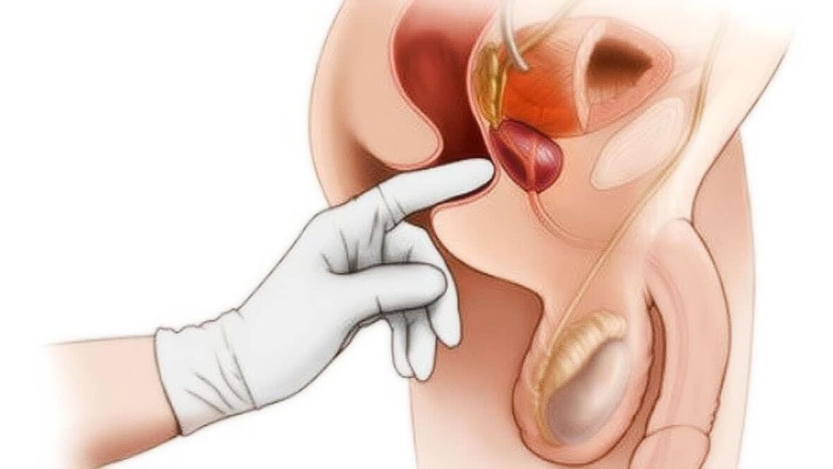 a prosztatitis beteg lehet a prostatitisben adenomul de prostata tratament