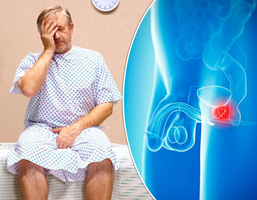 A prosztatagyulladásban szenvedő férfit betegség diagnosztizálják